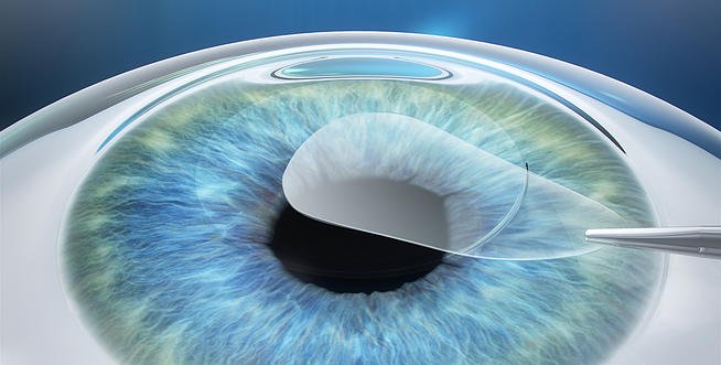 Tahap 2: pengeluaran lenticule melalui insisi 4mm