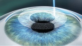 Tahap 1 FemtoLASIK: pembuatan flap kornea menggunakan laser femtosecond