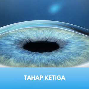 Laser Femtosecond Tahap 3