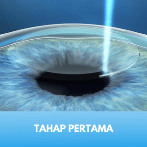 Laser Femtosecond Tahap 1